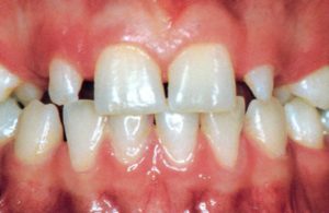 Syndrome de la dentition