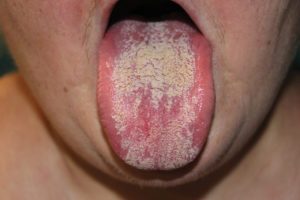 Inflammation de la langue