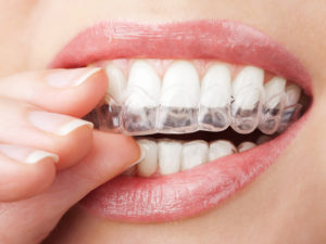 Maintenir la blancheur des dents