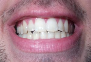 types de dents