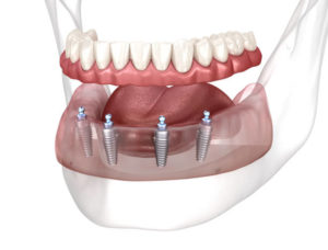 Prothèse dentaire complet sur quatre implants